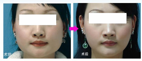 改臉型手術(shù)風(fēng)險大不大呢