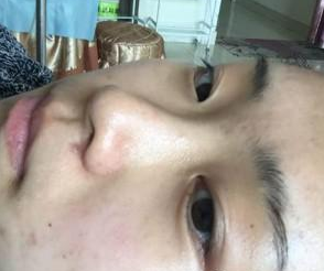 玻尿酸隆鼻 拍照的時(shí)候我才意識(shí)到鼻子有多重要 - 珍美網(wǎng)
