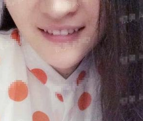 玻尿酸豐下巴 變小v臉真的很開(kāi)心 - 珍美網(wǎng)