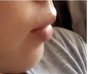 玻尿酸豐下巴 完美臉型從下巴開始 - 珍美網(wǎng)