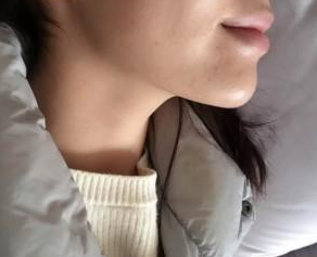 玻尿酸豐下巴  完美臉型從下巴開始