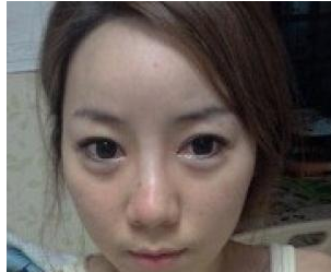 脂肪面部填充+PRP 變成正妹指數(shù)爆表 - 珍美網(wǎng)