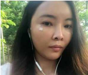 自體脂肪填充  重新找回美麗動(dòng)人的我 - 珍美網(wǎng)