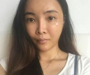 自體脂肪填充  重新找回美麗動人的我