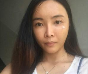 自體脂肪填充  重新找回美麗動(dòng)人的我 - 珍美網(wǎng)