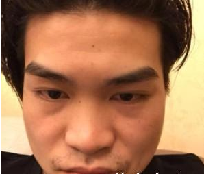 假體隆鼻 帥氣的側(cè)顏迷倒妹子不是難事 - 珍美網(wǎng)