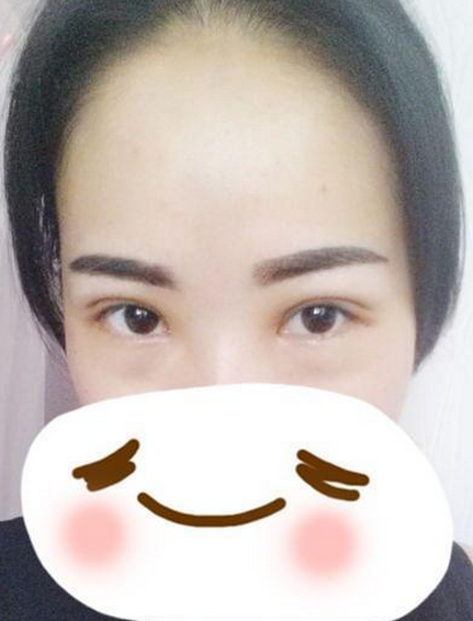 割雙眼皮手術(shù)  讓我重新感受到我的不一樣的美麗