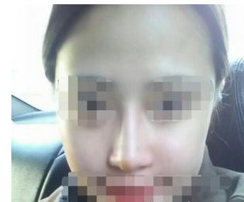 玻尿酸填充鼻梁  精致立體的五官讓我美的不要不要的 - 珍美網(wǎng)
