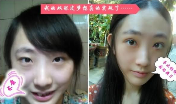 雙眼皮手術(shù) 小眼變大眼真的美出一個境界