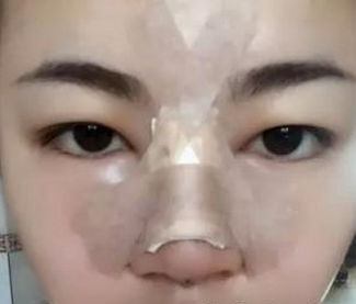 假體隆鼻 讓我更加有氣質了 - 珍美網(wǎng)