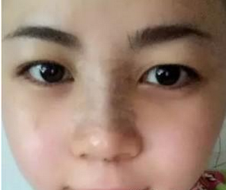 假體隆鼻 讓我更加有氣質了 - 珍美網(wǎng)