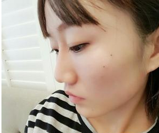 玻尿酸面部填充 快速告別蒼老的現(xiàn)象實現(xiàn)活力美的自己