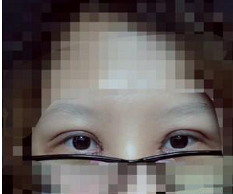 雙眼皮手術  眼睛變亮變大更讓人喜愛 - 珍美網(wǎng)