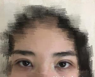 雙眼皮手術(shù) 眼睛變亮變大更讓人喜愛