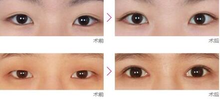 開(kāi)眼角手術(shù)會(huì)不會(huì)留下疤痕呢 - 珍美網(wǎng)