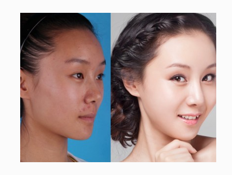 彩光嫩膚后會不會反彈呢