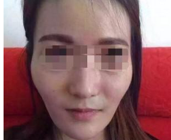 自體脂肪面部填充 煥然一新  - 珍美網(wǎng)