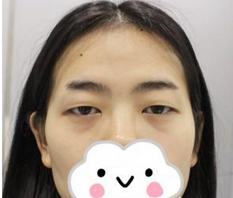 宜昌市伍家崗區(qū)中愛美容門診部李登進(jìn)醫(yī)生割雙眼皮案例:雙眼皮手 - 珍美網(wǎng)