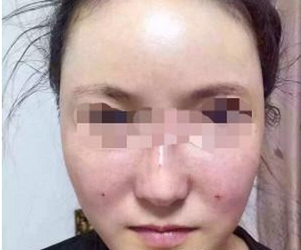 宜昌市伍家崗區(qū)中愛美容門診部李登進醫(yī)生割雙眼皮案例：雙眼皮手
