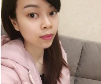 玻尿酸隆下巴  臉部變得柔和讓我更加美麗
