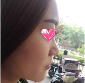 韓國伊婉大分子玻尿酸隆鼻 變側(cè)顏美麗小仙女 - 珍美網(wǎng)
