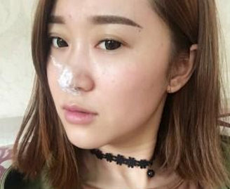 韓國伊婉大分子玻尿酸隆鼻 變側(cè)顏美麗小仙女 - 珍美網(wǎng)