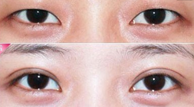 埋線雙眼皮恢復(fù)期是多久?