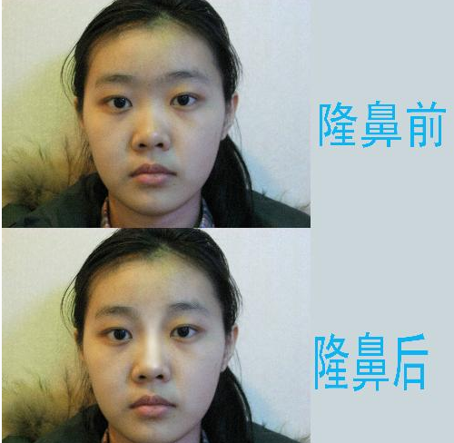 自體軟骨隆鼻會(huì)不會(huì)安全