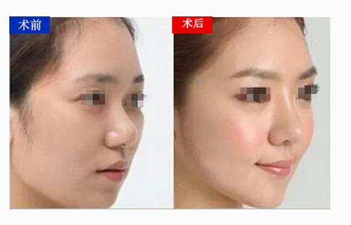 自體脂肪豐蘋果肌恢復(fù)需要多長(zhǎng)時(shí)間