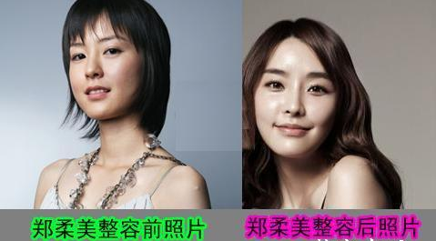 鄭柔美整容了嗎？ 面容突變判若兩人嚇壞網(wǎng)友 - 珍美網(wǎng)