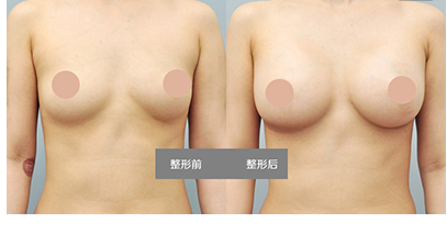 自體脂肪隆胸手術后手感自然嗎