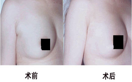 副乳切除后效果怎么樣呢?