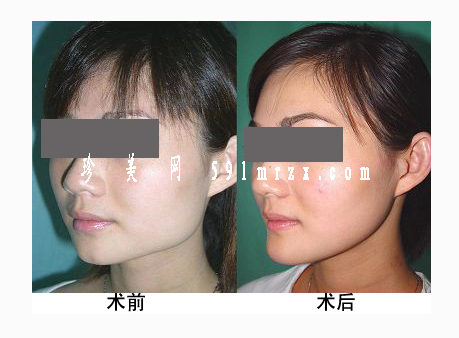 影響下頜角整形手術(shù)安全的因素有哪些呢