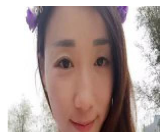 豐全臉手術(shù) 讓我膠原蛋白滿滿光彩照人 - 珍美網(wǎng)