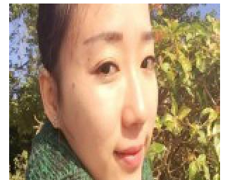 豐全臉手術(shù) 讓我膠原蛋白滿滿光彩照人 - 珍美網(wǎng)