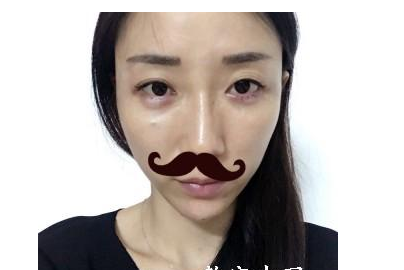 豐全臉手術(shù) 讓我膠原蛋白滿滿光彩照人 - 珍美網(wǎng)