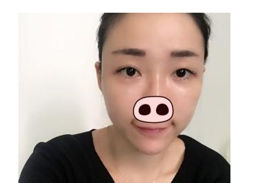豐全臉手術(shù) 讓我膠原蛋白滿滿光彩照人 - 珍美網(wǎng)