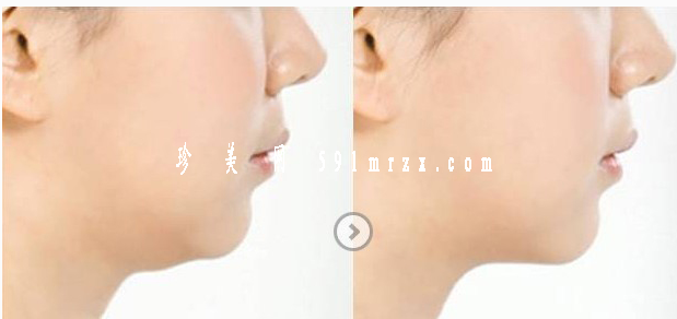 面部吸脂瘦臉多長時間可以恢復(fù)正常呢 - 珍美網(wǎng)