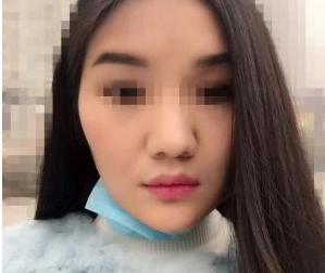 玻尿酸豐下巴 讓我擺脫短下巴的不美麗 - 珍美網(wǎng)