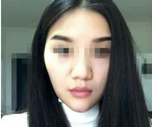 玻尿酸豐下巴 讓我擺脫短下巴的不美麗