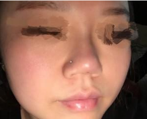 玻尿酸注射隆鼻  讓我找回美麗的自信