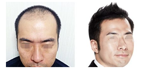 頭發(fā)種植手術(shù)安不安全呢