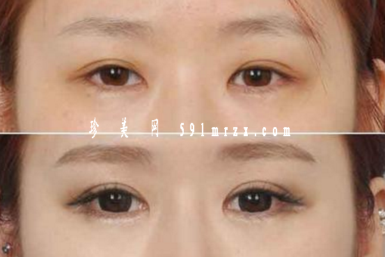 開眼角手術(shù)后如何快速消腫呢