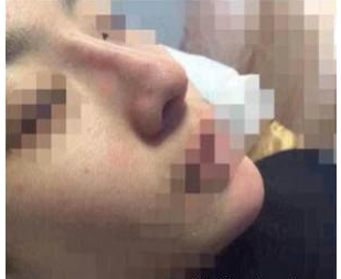 玻尿酸隆鼻 塌鼻變高挺美鼻分分鐘美出境界