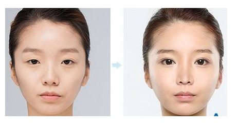 上眼瞼下垂的應該怎么辦呢