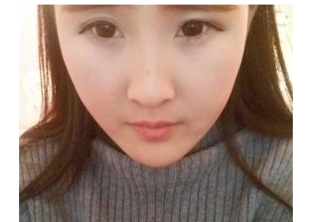 玻尿酸豐下巴 美麗的下巴讓我重獲自信 - 珍美網(wǎng)