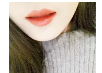 玻尿酸豐下巴   美麗的下巴讓我重獲自信