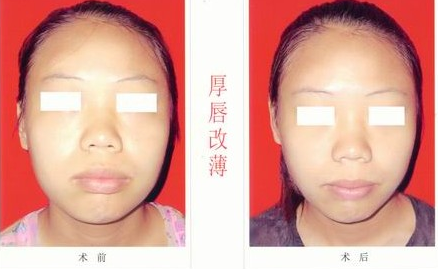厚唇變薄手術(shù)價(jià)格多少錢