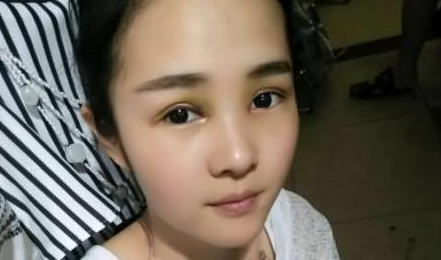 雙眼皮手術(shù) 讓我更加美麗迷人 - 珍美網(wǎng)