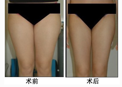 顧清大腿吸脂手術(shù)怎么樣
